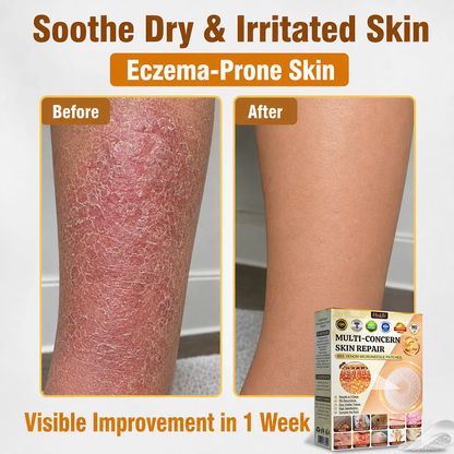 ✨Hiskin ®MULTI-CONCERN SKIN REPAIR BEE VENOM MICRONEEDLE PATCHES