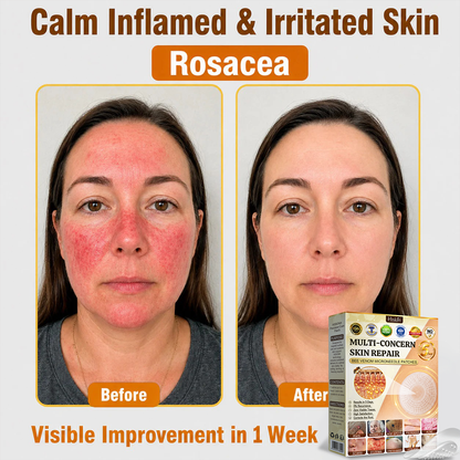 ✨Hiskin ®MULTI-CONCERN SKIN REPAIR BEE VENOM MICRONEEDLE PATCHES