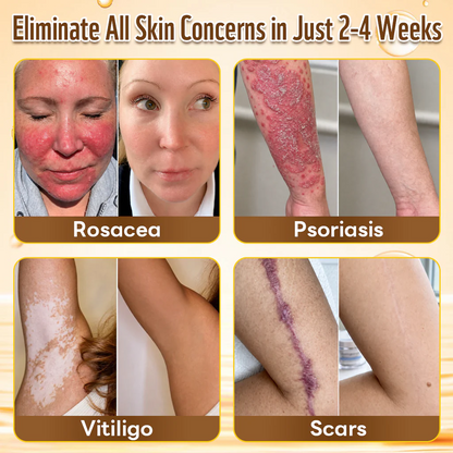 ✨Hiskin ®MULTI-CONCERN SKIN REPAIR BEE VENOM MICRONEEDLE PATCHES