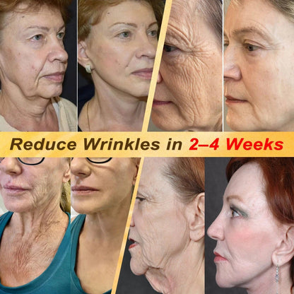✨Hiskin ®MULTI-CONCERN SKIN REPAIR BEE VENOM MICRONEEDLE PATCHES
